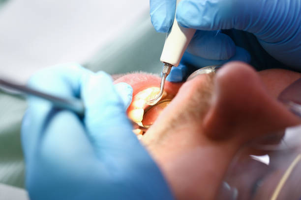 Best Emergency Tooth Extraction in Houston, TX